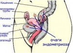 Наружный эндометриоз