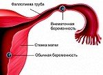 ХГЧ при внематочной беременности