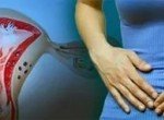 Эндометриоз: причины, симптомы, диагностика, методы лечения