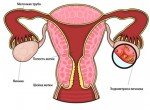 Эндометриоз матки – причины и лечение