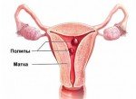 Полипы эндометрия матки и их лечение
